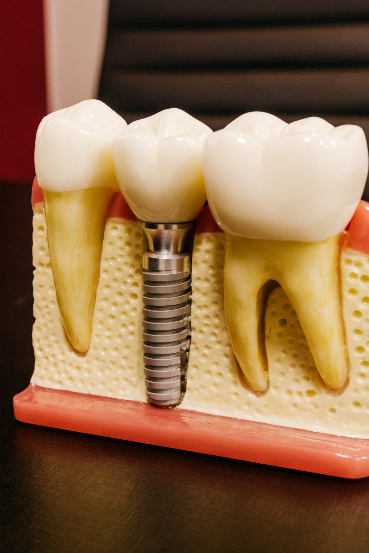 Featured image for “How To Maintain Dental Implants For Long-Term Success And Durability?”