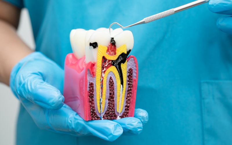 Featured image for “Vital Signs of Root Canal Infection to Take Seriously”