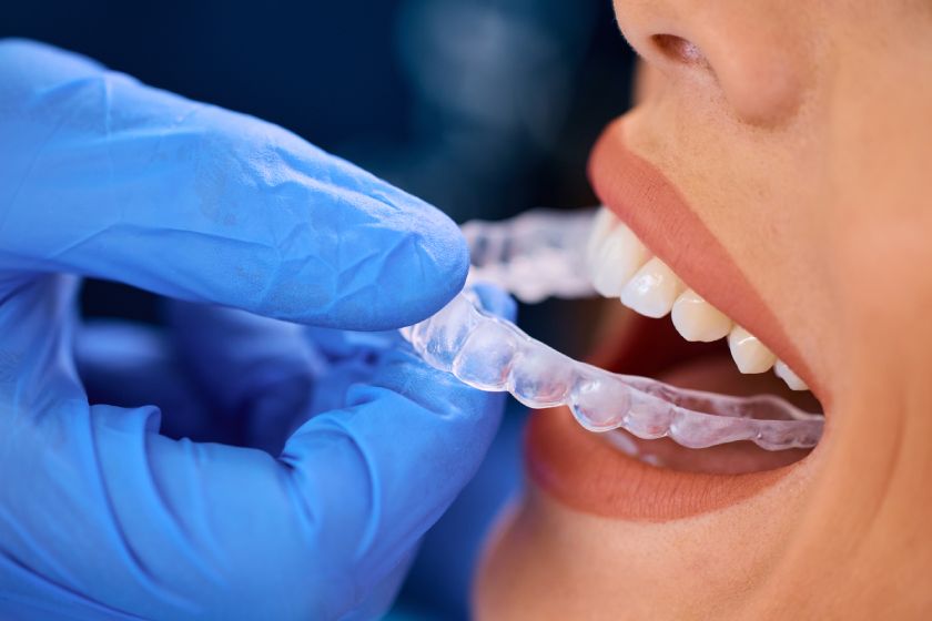 Featured image for “Can Invisalign Fix an Overbite? Know About Clear Aligner Treatment”